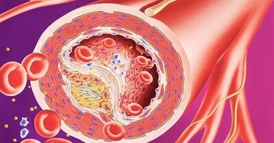 Levensverwachting bij type 2-diabetes wordt meer bepaald door HbA1c dan RR/lipiden