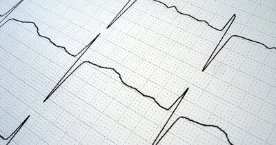 SGLT2-remmers verminderen AF-risico bij oudere patiënten met T2D